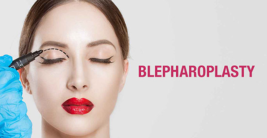 Blepharoplasty